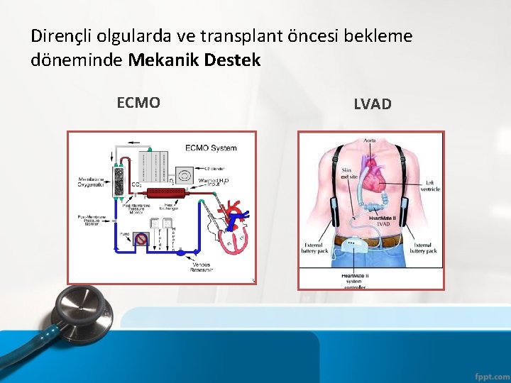 Dirençli olgularda ve transplant öncesi bekleme döneminde Mekanik Destek ECMO LVAD 