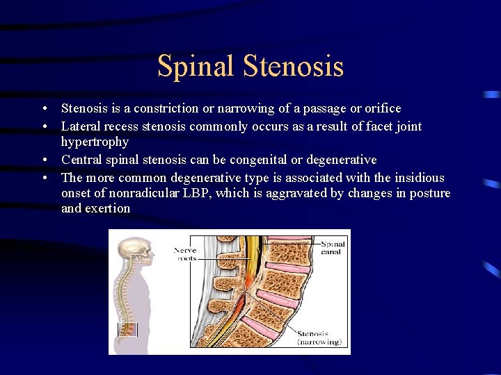 Spinal Stenosis • Stenosis is a constriction or narrowing of a passage or orifice