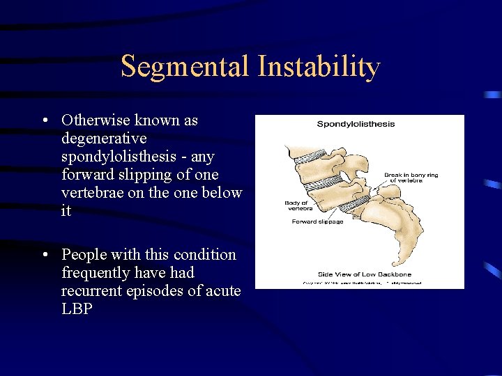 Segmental Instability • Otherwise known as degenerative spondylolisthesis - any forward slipping of one