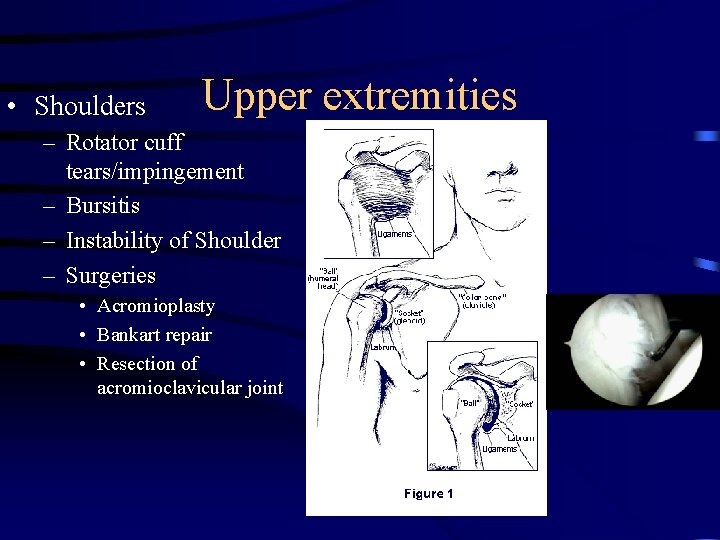  • Shoulders Upper extremities – Rotator cuff tears/impingement – Bursitis – Instability of