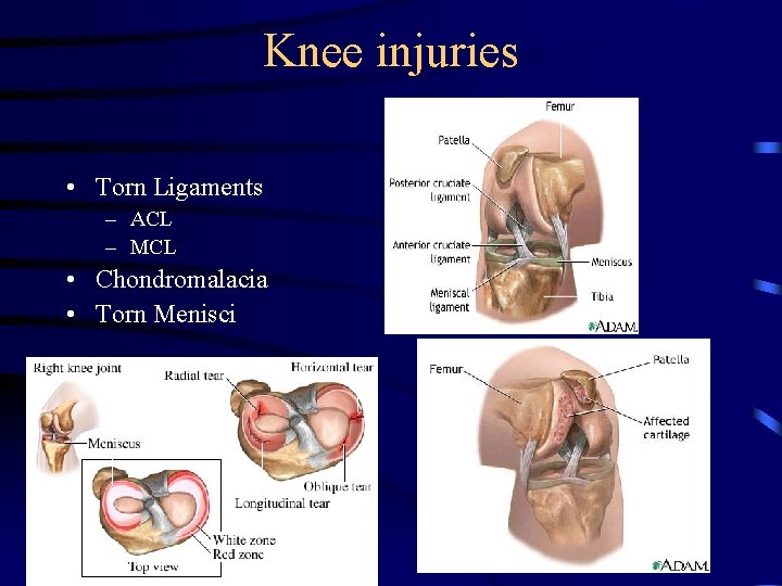 Knee injuries • Torn Ligaments – ACL – MCL • Chondromalacia • Torn Menisci