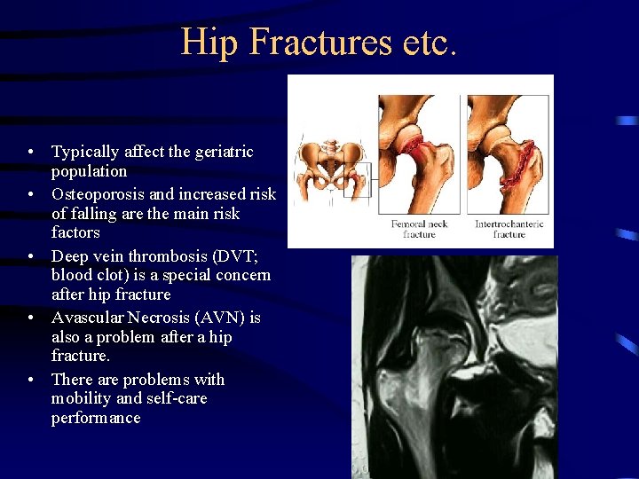 Hip Fractures etc. • Typically affect the geriatric population • Osteoporosis and increased risk