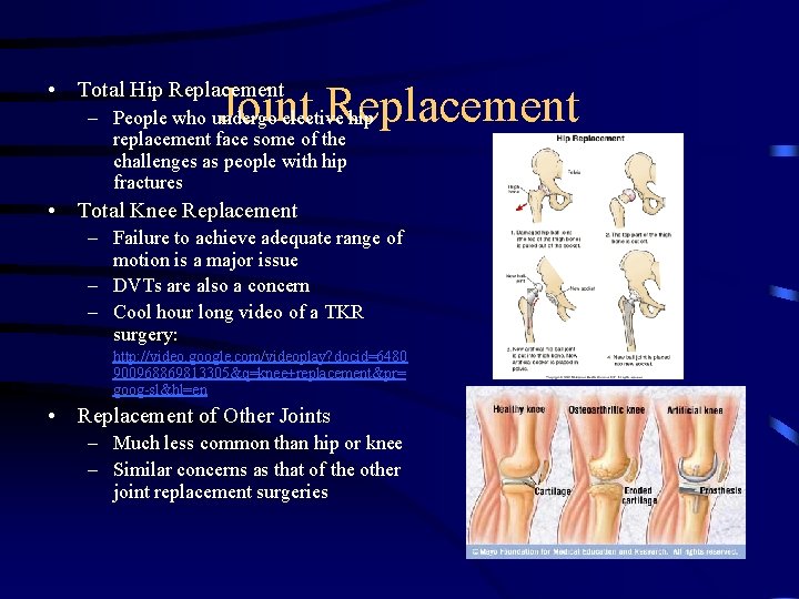  • Total Hip Replacement Joint Replacement – People who undergo elective hip replacement
