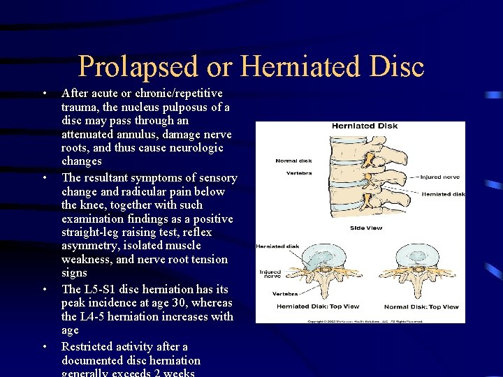 Prolapsed or Herniated Disc • • After acute or chronic/repetitive trauma, the nucleus pulposus