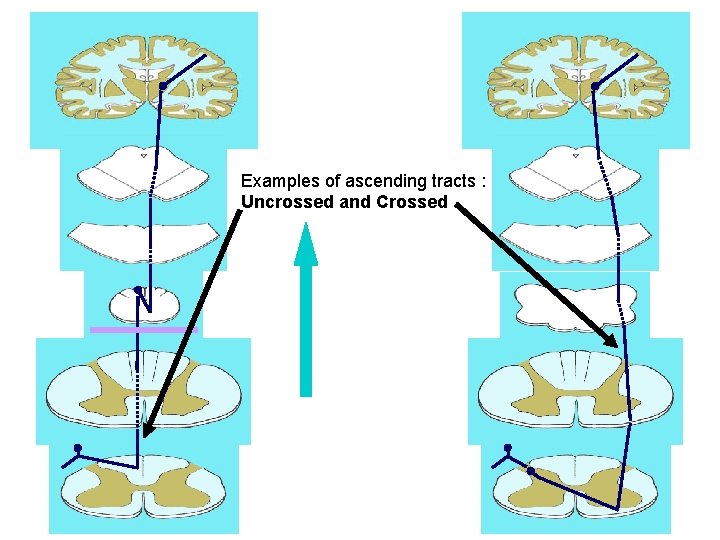 Examples of ascending tracts : Uncrossed and Crossed 