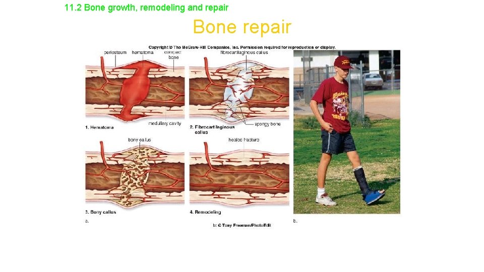 11. 2 Bone growth, remodeling and repair Bone repair 
