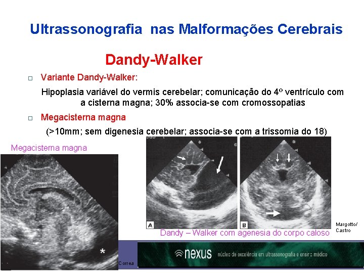 Ultrassonografia nas Malformações Cerebrais Dandy-Walker Variante Dandy-Walker: Hipoplasia variável do vermis cerebelar; comunicação do