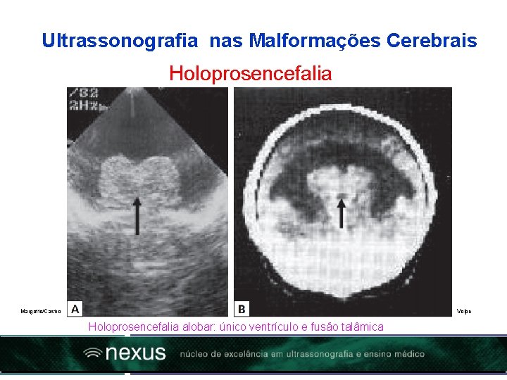 Ultrassonografia nas Malformações Cerebrais Holoprosencefalia Margotto/Castro Volpe Holoprosencefalia alobar: único ventrículo e fusão talâmica