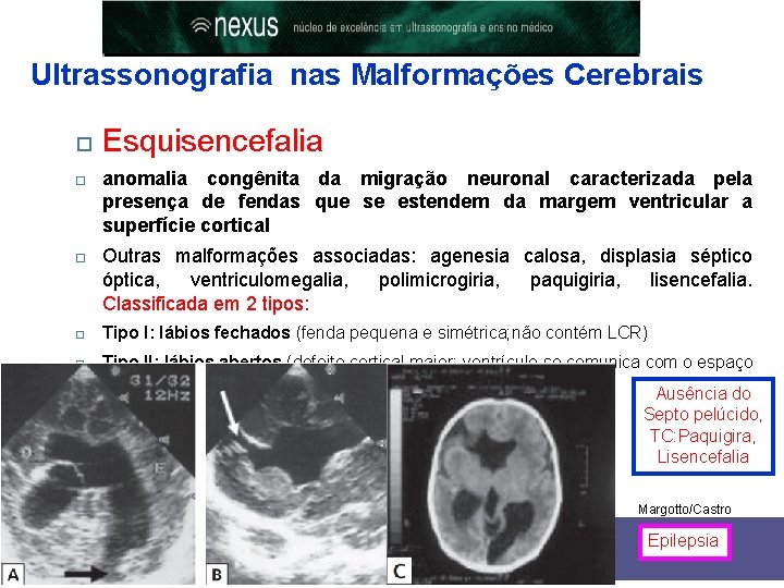 Ultrassonografia nas Malformações Cerebrais Esquisencefalia anomalia congênita da migração neuronal caracterizada pela presença de