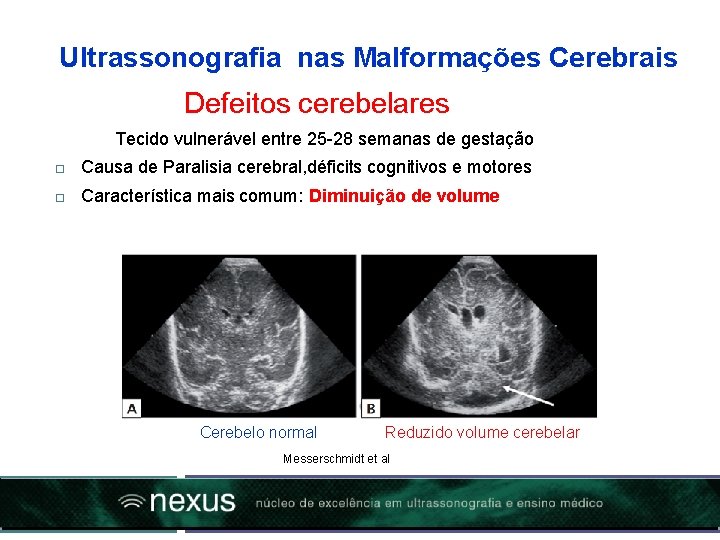 Ultrassonografia nas Malformações Cerebrais Defeitos cerebelares Tecido vulnerável entre 25 -28 semanas de gestação