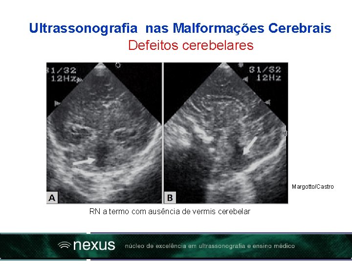 Ultrassonografia nas Malformações Cerebrais Defeitos cerebelares Margotto/Castro RN a termo com ausência de vermis