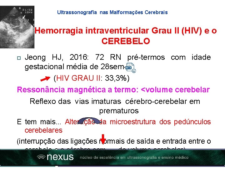 Ultrassonografia nas Malformações Cerebrais Hemorragia intraventricular Grau II (HIV) e o CEREBELO Jeong HJ,