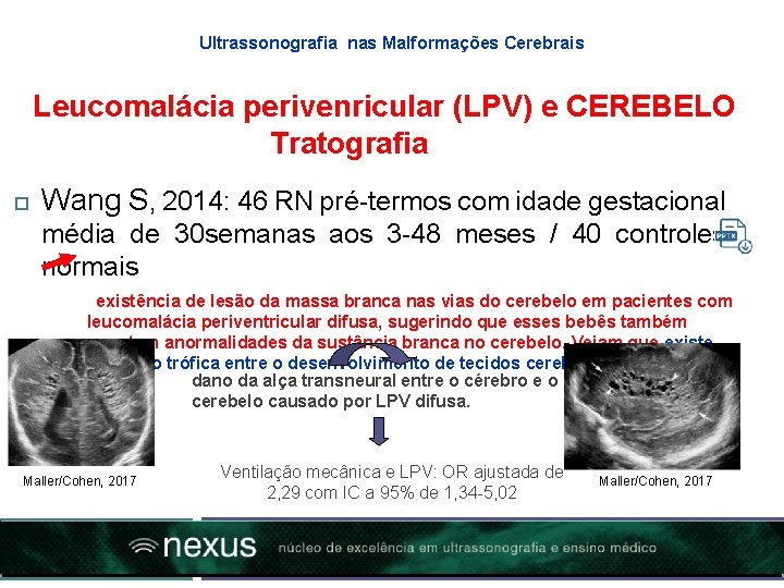 Ultrassonografia nas Malformações Cerebrais Leucomalácia perivenricular (LPV) e CEREBELO Tratografia Wang S, 2014: 46