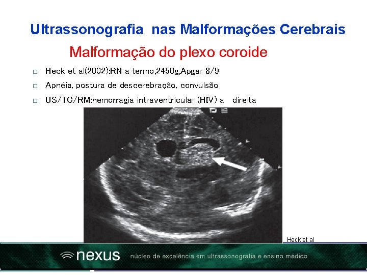 Ultrassonografia nas Malformações Cerebrais Malformação do plexo coroide Heck et al(2002): RN a termo,