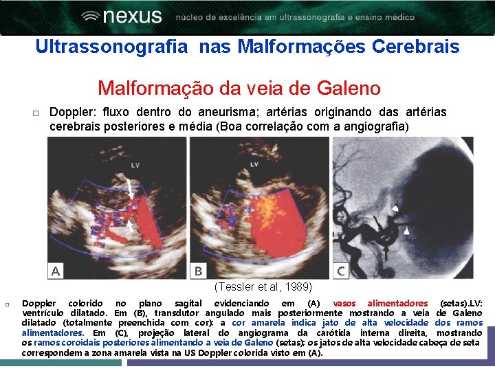 Ultrassonografia nas Malformações Cerebrais Malformação da veia de Galeno Doppler: fluxo dentro do aneurisma;