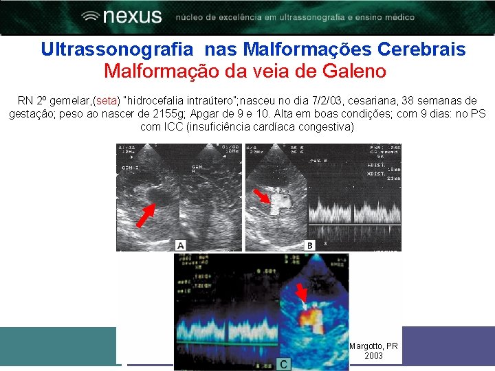 Ultrassonografia nas Malformações Cerebrais Malformação da veia de Galeno RN 2º gemelar, (seta) “hidrocefalia