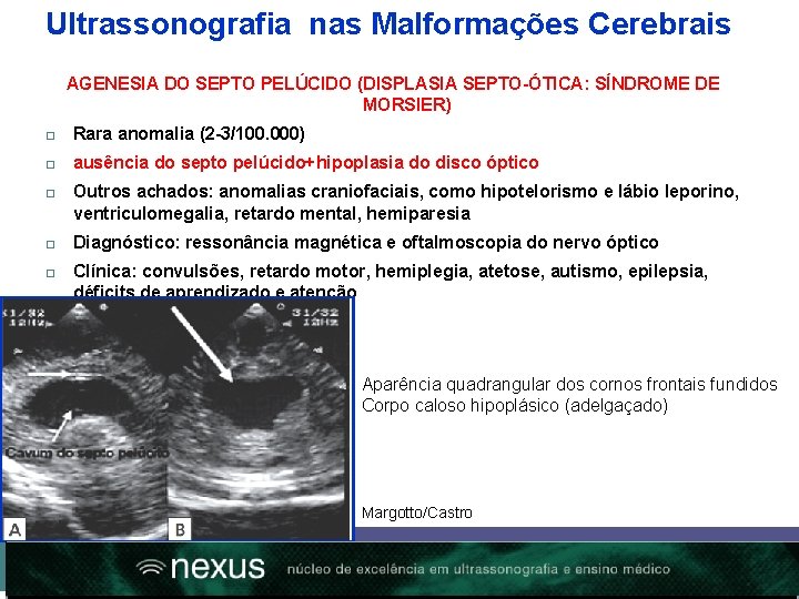 Ultrassonografia nas Malformações Cerebrais AGENESIA DO SEPTO PELÚCIDO (DISPLASIA SEPTO-ÓTICA: SÍNDROME DE MORSIER) Rara