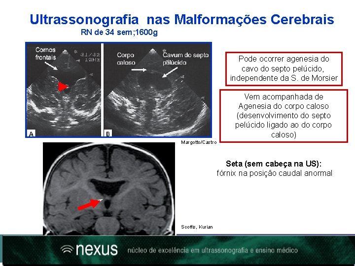 Ultrassonografia nas Malformações Cerebrais RN de 34 sem; 1600 g Pode ocorrer agenesia do