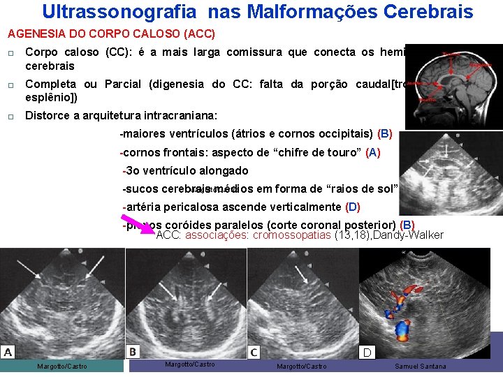 Ultrassonografia nas Malformações Cerebrais AGENESIA DO CORPO CALOSO (ACC) Corpo caloso (CC): é a