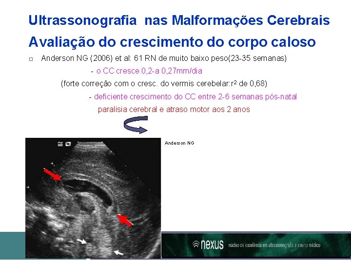 Ultrassonografia nas Malformações Cerebrais Avaliação do crescimento do corpo caloso Anderson NG (2006) et