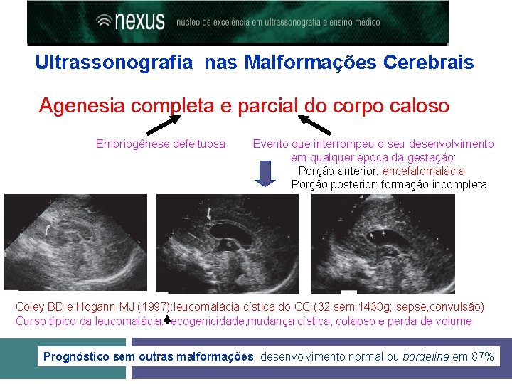 Ultrassonografia nas Malformações Cerebrais Agenesia completa e parcial do corpo caloso Embriogênese defeituosa Evento