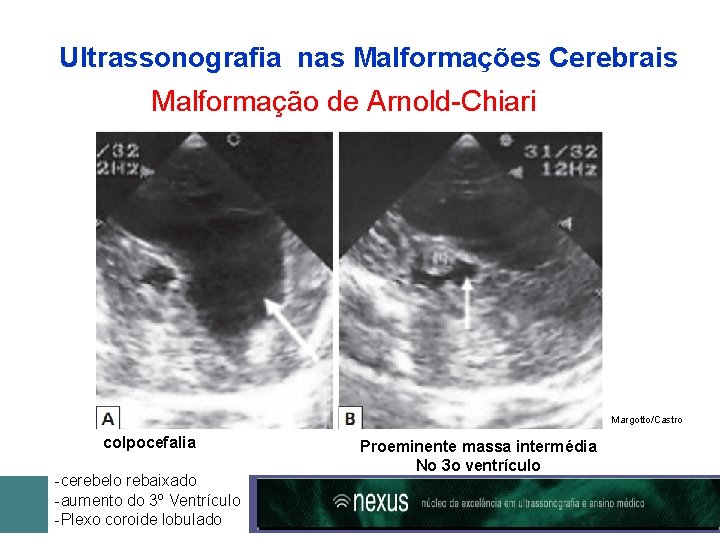 Ultrassonografia nas Malformações Cerebrais Malformação de Arnold-Chiari Margotto/Castro colpocefalia -cerebelo rebaixado -aumento do 3º