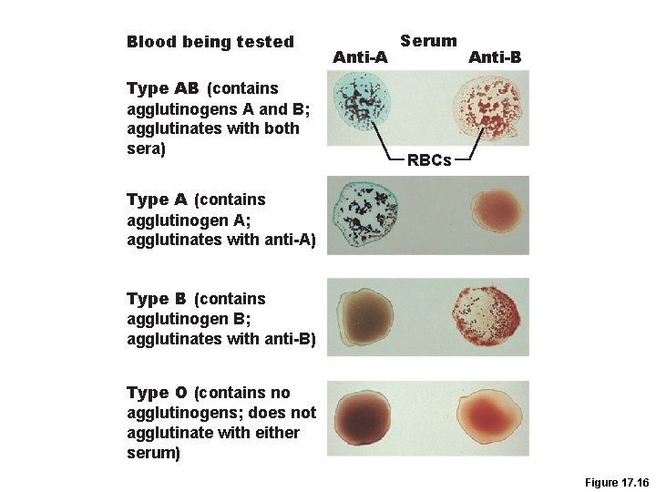 Blood being tested Type AB (contains agglutinogens A and B; agglutinates with both sera)