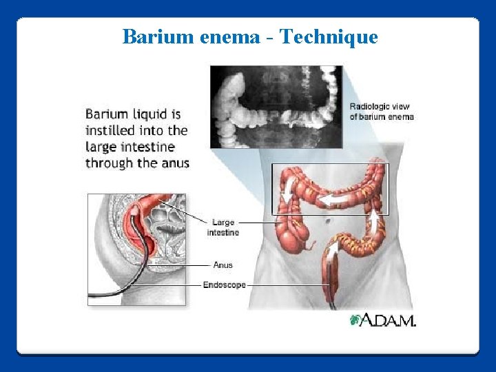 Barium enema - Technique 