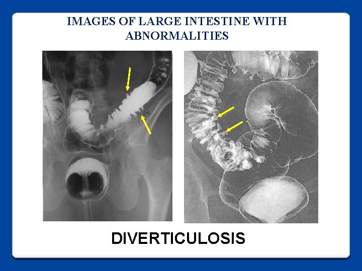 IMAGES OF LARGE INTESTINE WITH ABNORMALITIES DIVERTICULOSIS 