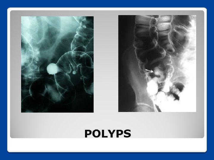 POLYPS 