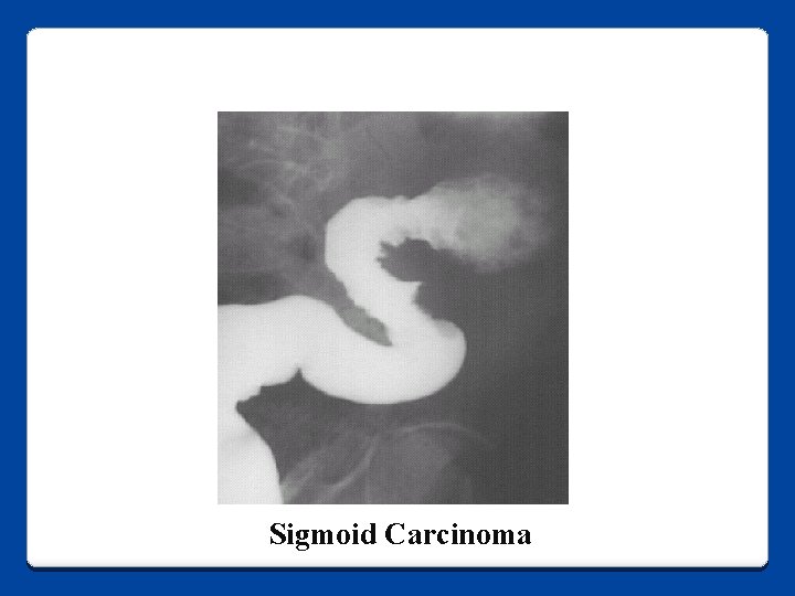 Sigmoid Carcinoma 