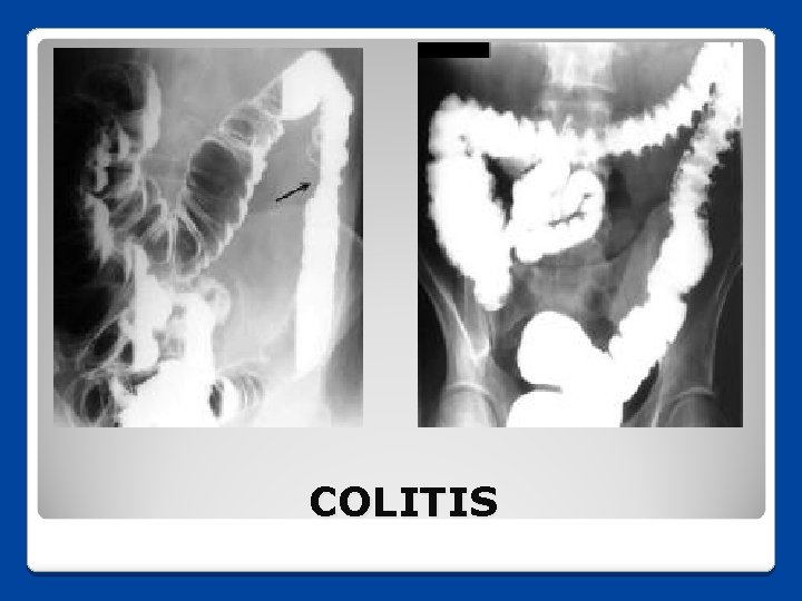 COLITIS 