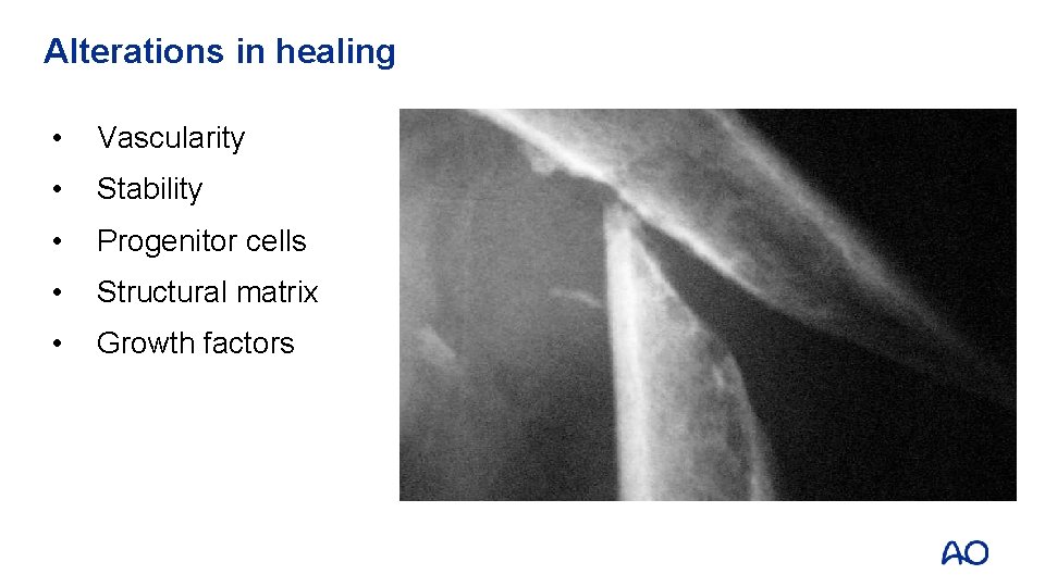 Alterations in healing • Vascularity • Stability • Progenitor cells • Structural matrix •