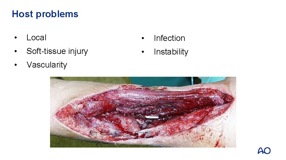 Host problems • Local • Infection • Soft-tissue injury • Instability • Vascularity 
