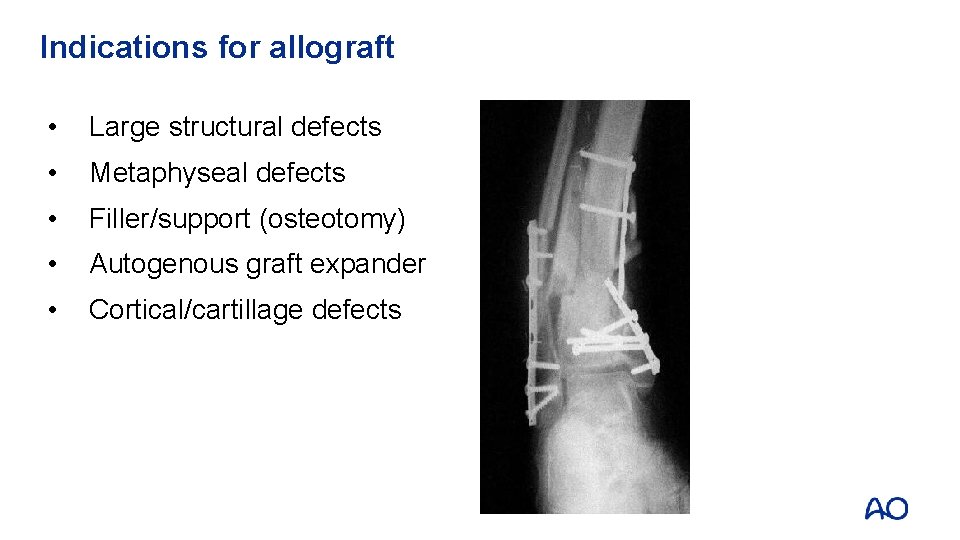 Indications for allograft • Large structural defects • Metaphyseal defects • Filler/support (osteotomy) •