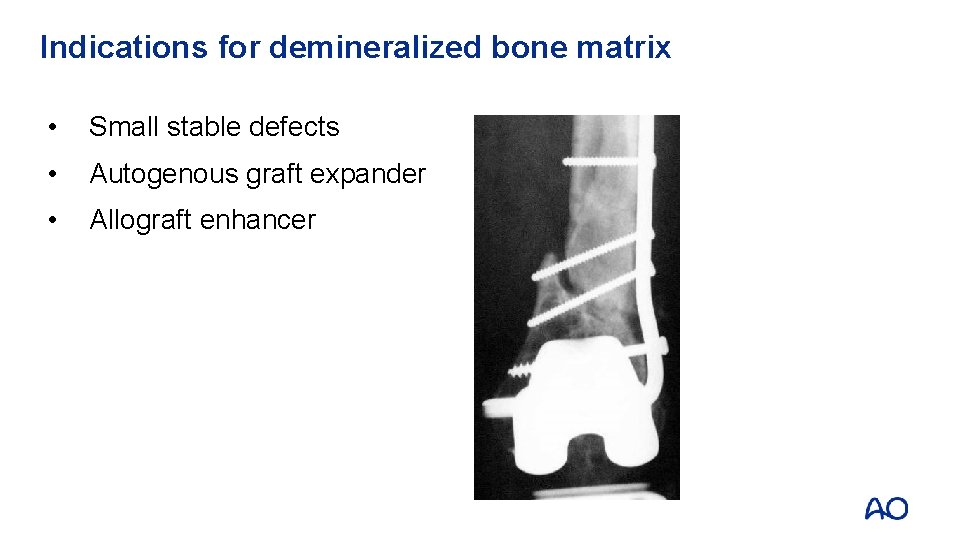 Indications for demineralized bone matrix • Small stable defects • Autogenous graft expander •