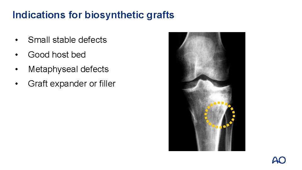 Indications for biosynthetic grafts • Small stable defects • Good host bed • Metaphyseal