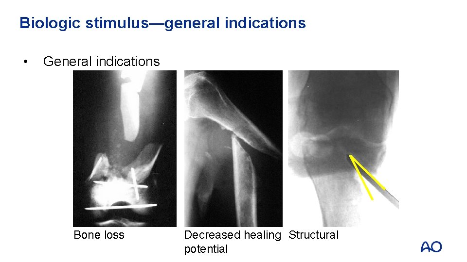 Biologic stimulus—general indications • General indications Bone loss Decreased healing Structural potential 