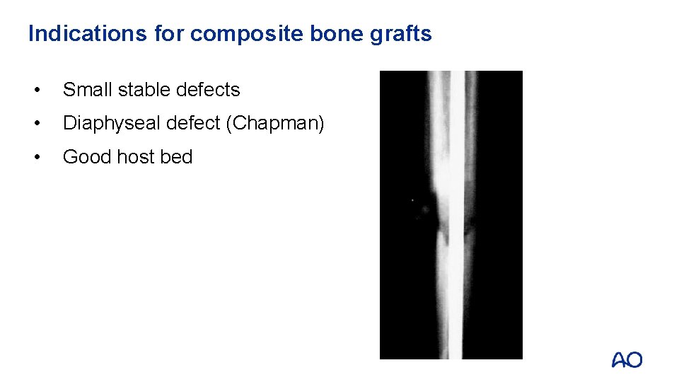 Indications for composite bone grafts • Small stable defects • Diaphyseal defect (Chapman) •