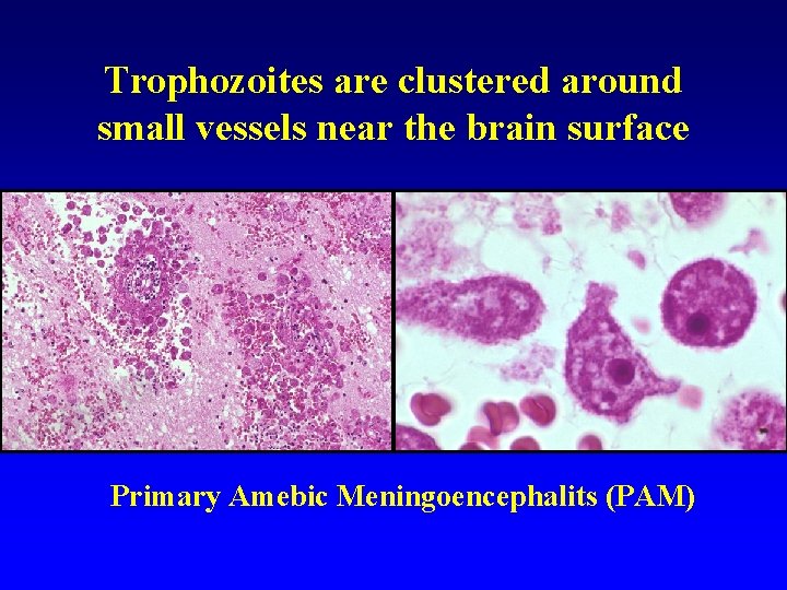 Trophozoites are clustered around small vessels near the brain surface Primary Amebic Meningoencephalits (PAM)