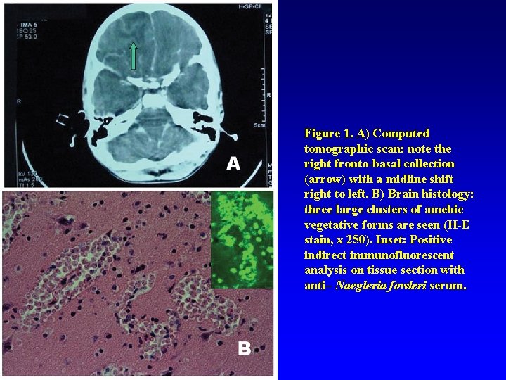 Figure 1. A) Computed tomographic scan: note the right fronto-basal collection (arrow) with a