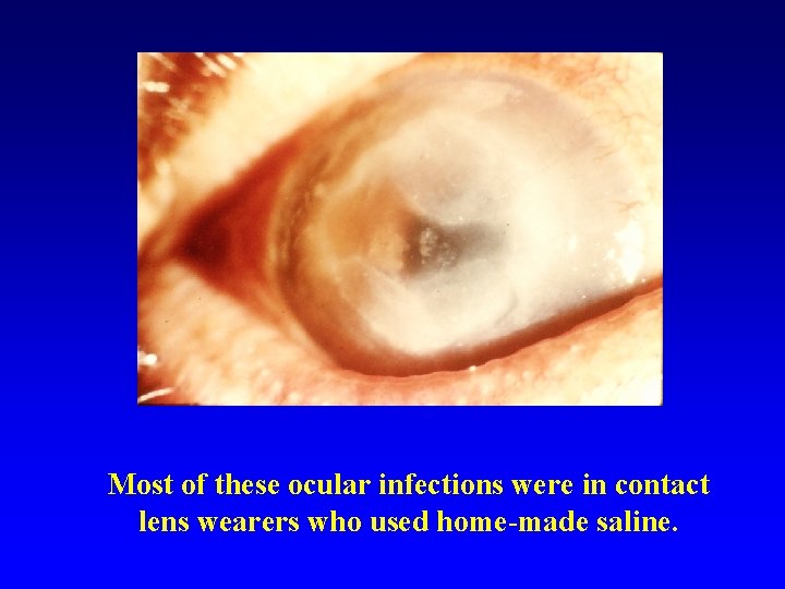 Most of these ocular infections were in contact lens wearers who used home-made saline.