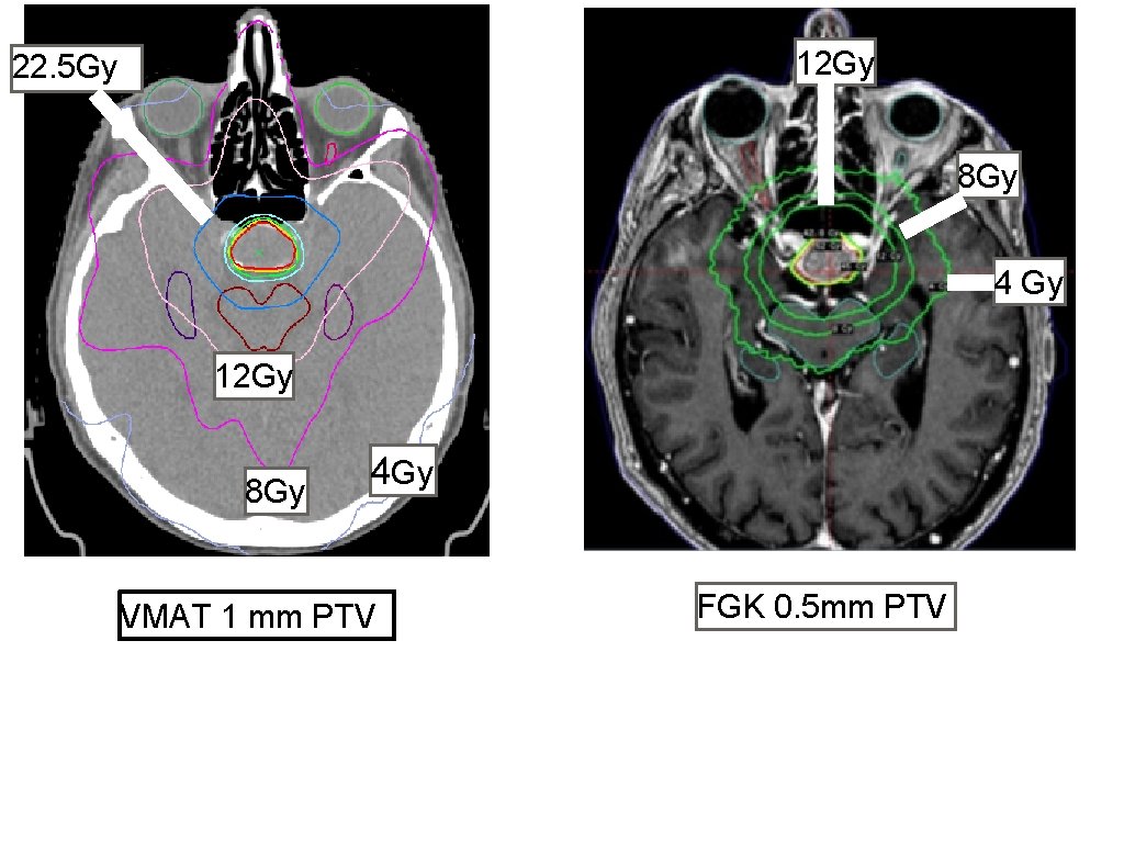 The Bristol Gamma Knife Centre NICE Adult Brain
