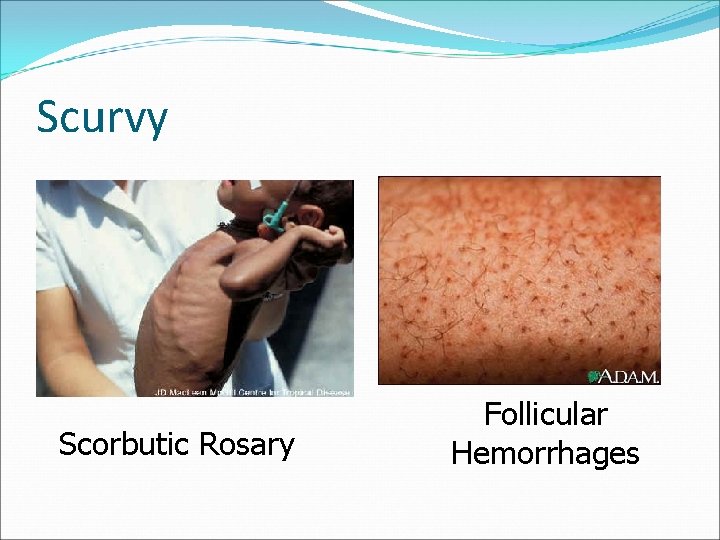 Scurvy Scorbutic Rosary Follicular Hemorrhages 