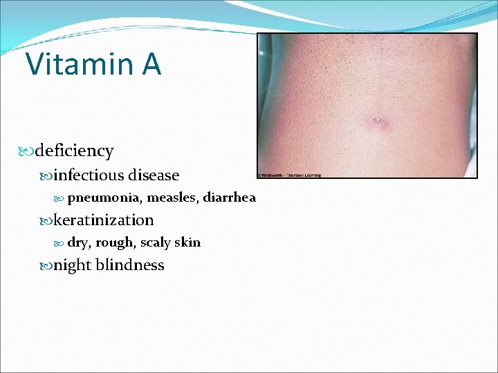 Vitamin A deficiency infectious disease pneumonia, measles, diarrhea keratinization dry, rough, scaly skin night