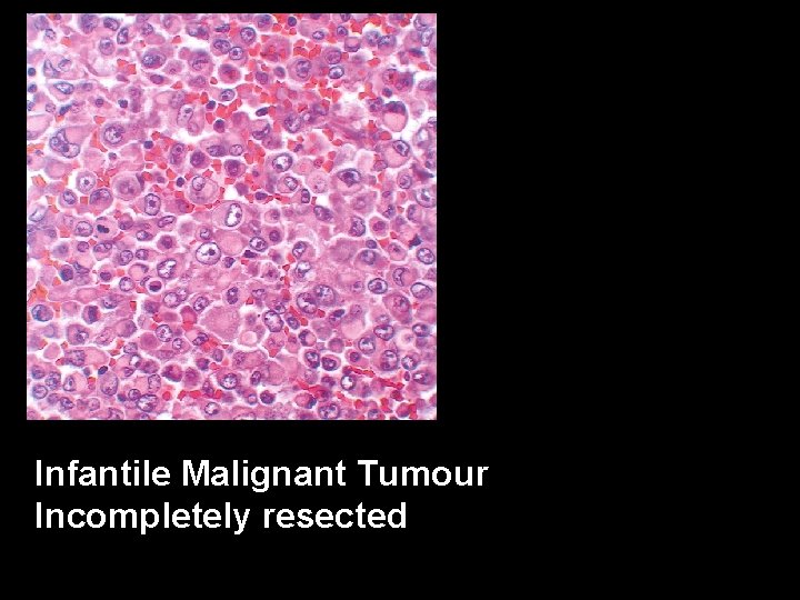 Infantile Malignant Tumour Incompletely resected 