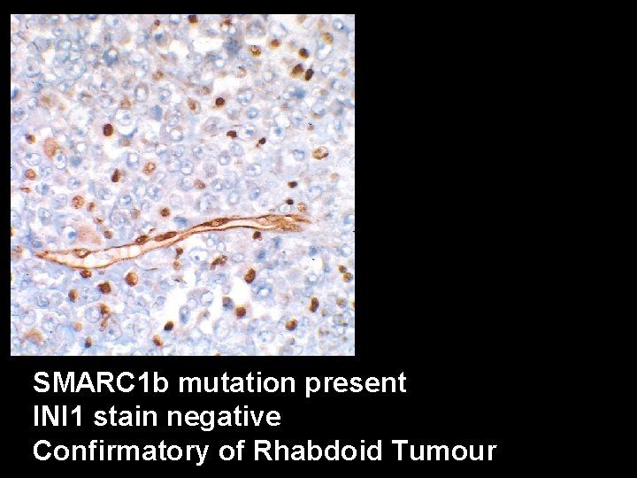 SMARC 1 b mutation present INI 1 stain negative Confirmatory of Rhabdoid Tumour 