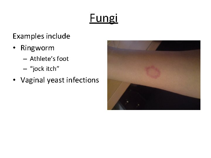 Fungi Examples include • Ringworm – Athlete’s foot – “jock itch” • Vaginal yeast