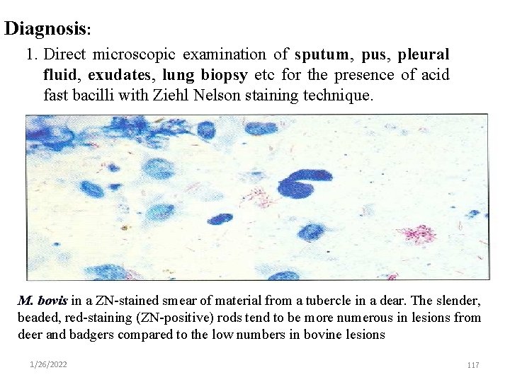 Diagnosis: 1. Direct microscopic examination of sputum, pus, pleural fluid, exudates, lung biopsy etc