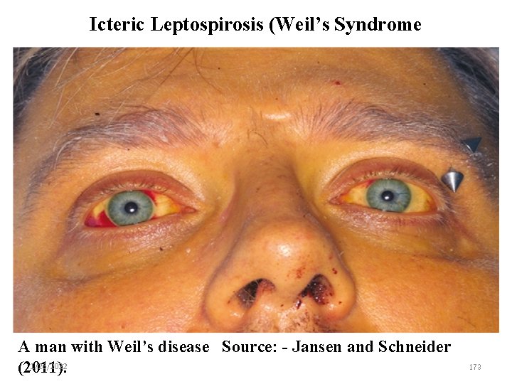 Icteric Leptospirosis (Weil’s Syndrome A man with Weil’s disease Source: - Jansen and Schneider